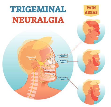 Trigeminal Neuralgia FAQ. . Can atypical trigeminal neuralgia go away